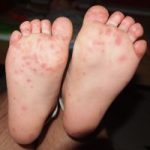Officials try to contain hand, foot and mouth outbreak Officials try to contain hand, foot and mouth outbreak